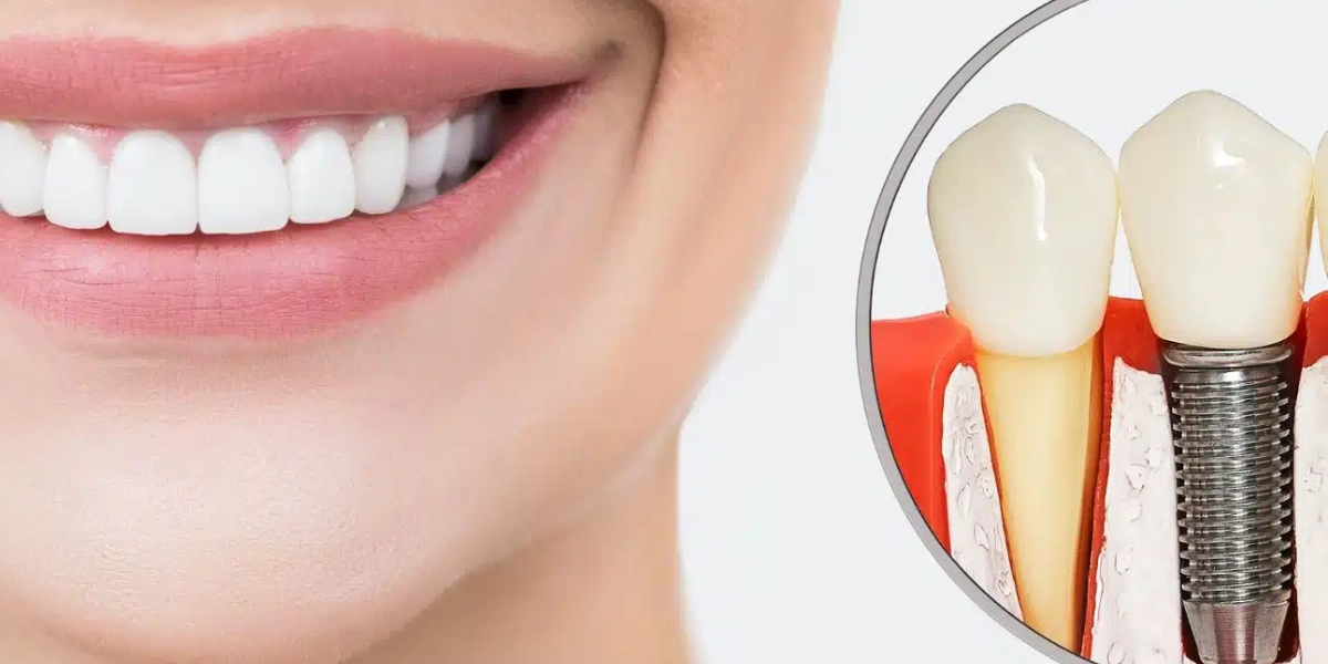 كم يستغرق التعافي بعد زراعة الأسنان؟