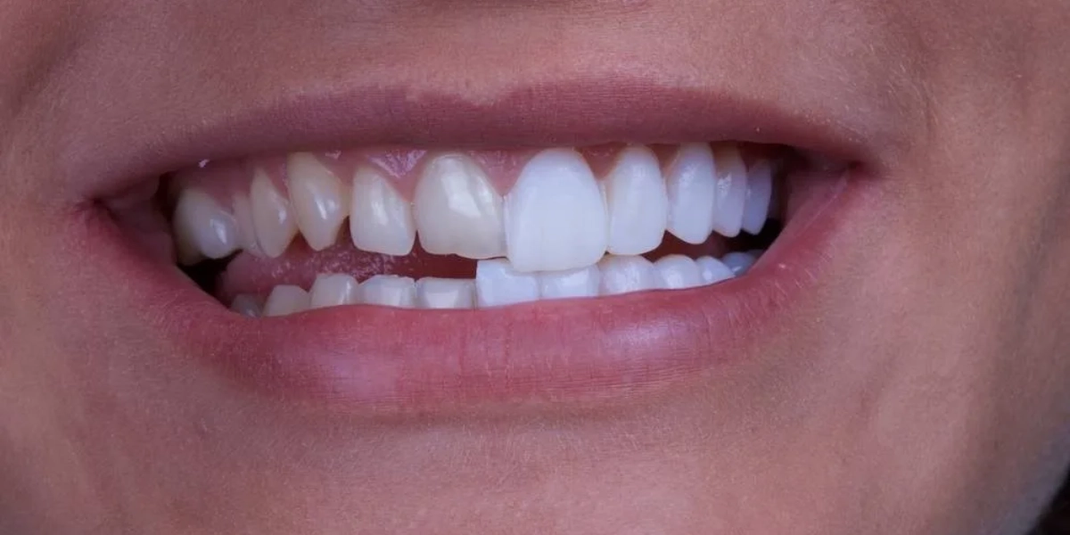 مشاكل الأسنان التي يعالجها الفينير