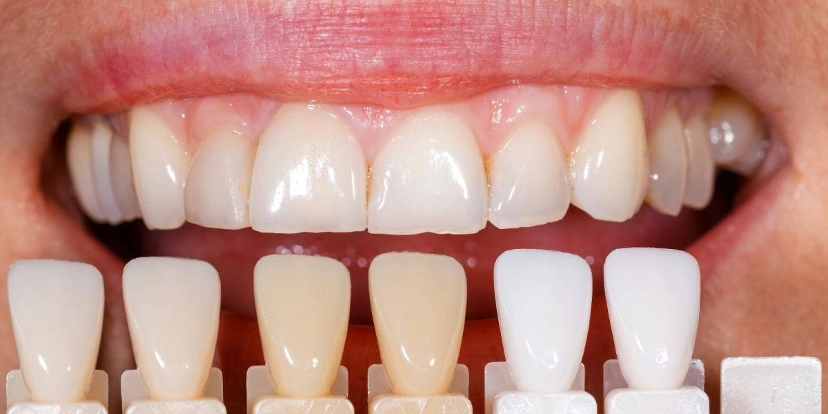 أبرز 7 اختلافات بين الفينير واللومينير يجب عليك معرفتها