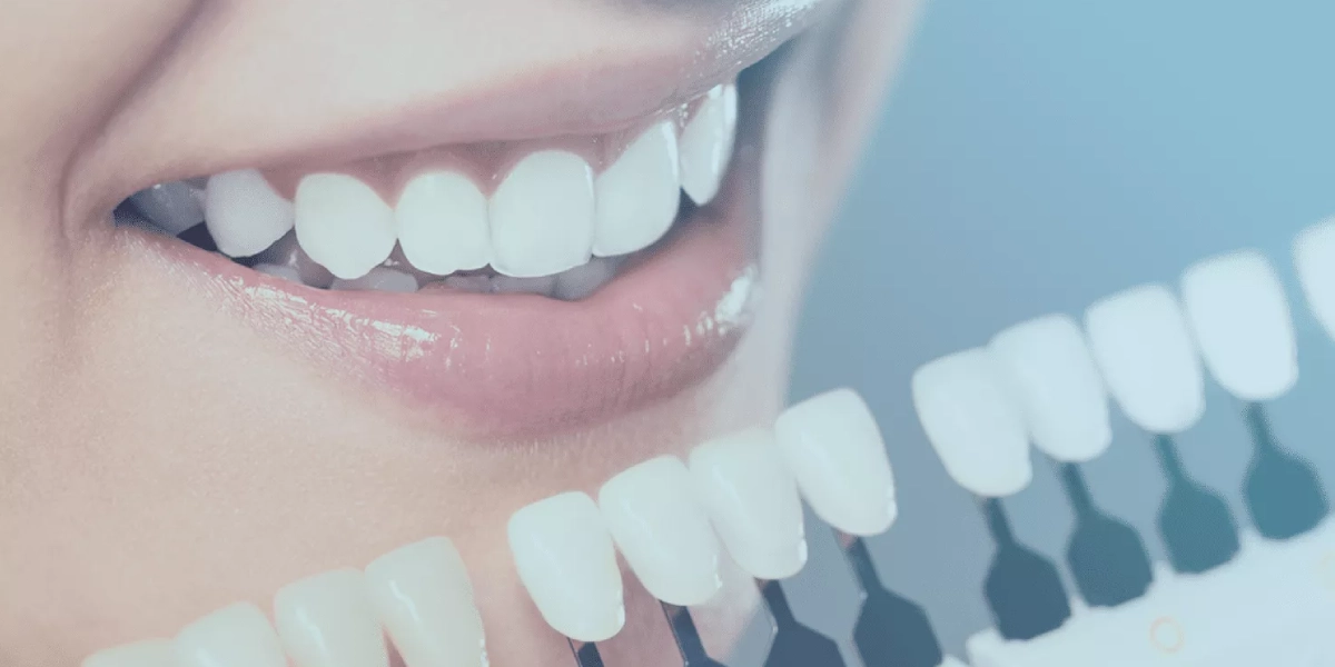 أنواع فينير الأسنان والمزايا والعيوب | دليل شامل من مركز بطل للأسنان