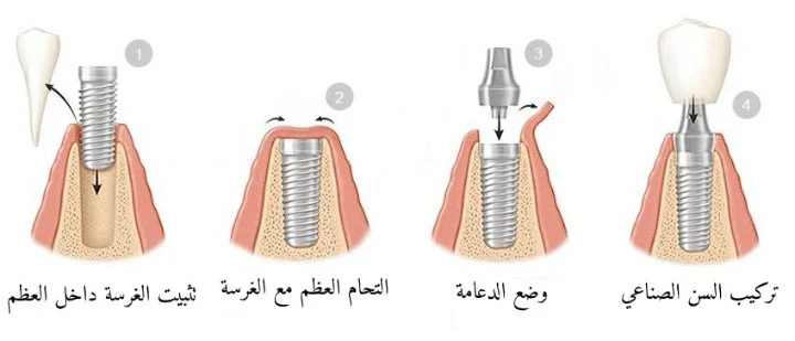 جراحة زراعة الاسنان الموجهة بالكمبيوتر