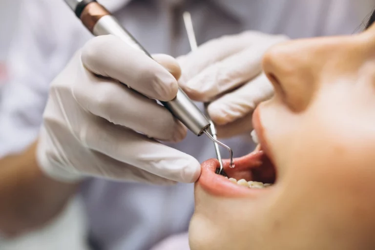 علاج تسوس الأسنان