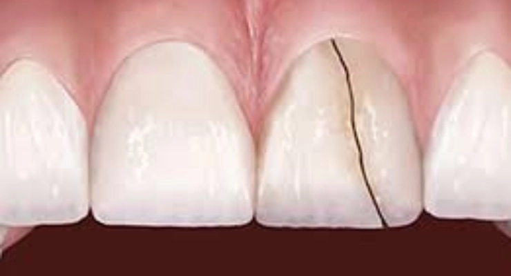 كسر أو تشقق السن