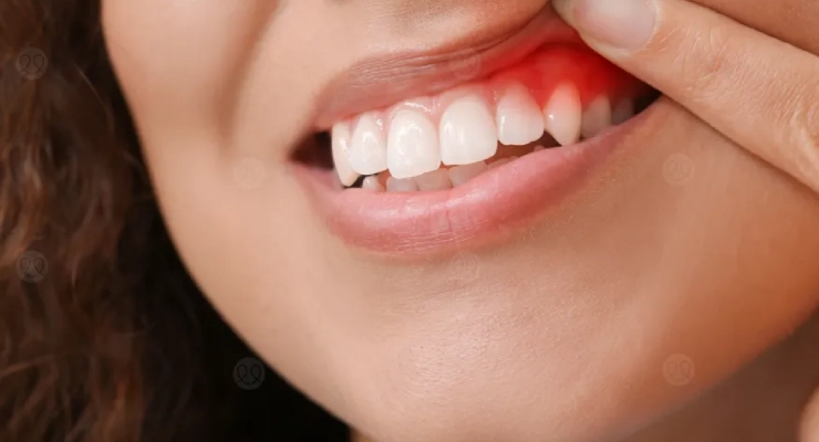 علاج مشاكل اللثة