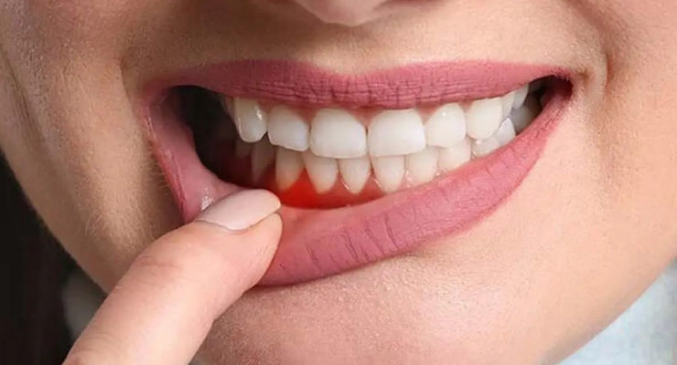 هل يمكن أن يتحول ألم اللثة إلى ألم عصب