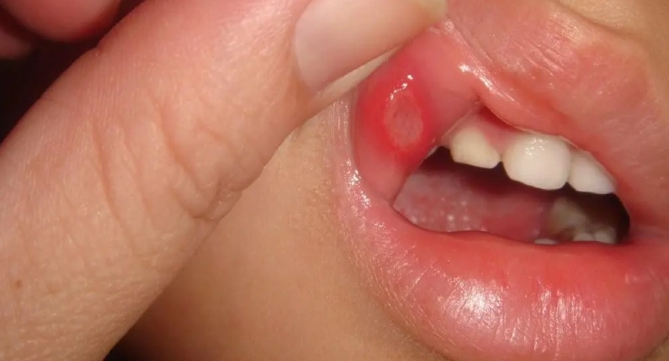 تكرار التهابات الفم
