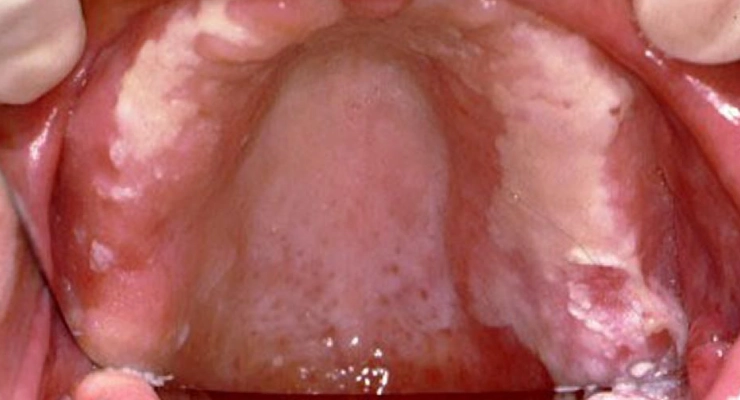 الحساسية والعدوى الفطرية كسبب خفي للتكرار