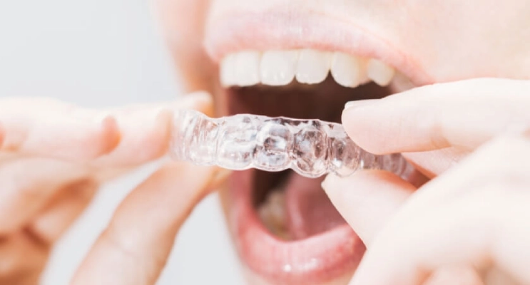 واقي الأسنان الليلي