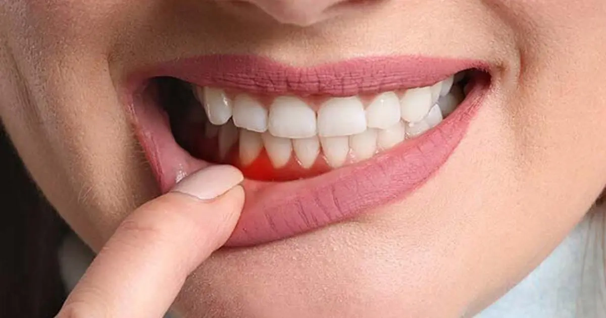 تميّز بين ألم اللثة وألم العصب