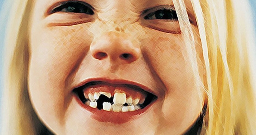 إصابات الأسنان عند الأطفال
