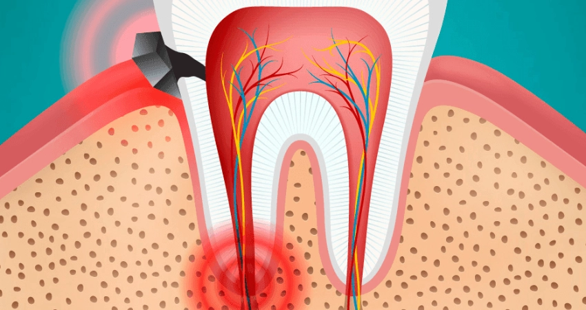 ما الفرق بين ألم العصب وألم اللثة؟
