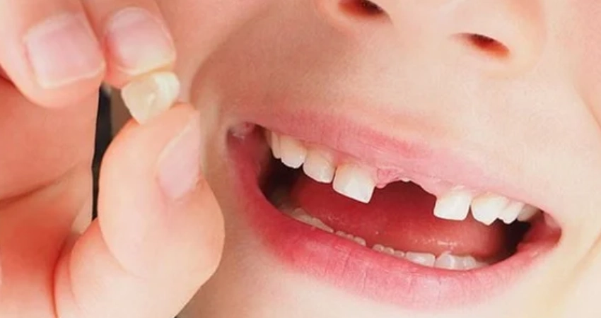 أسباب تأخر سقوط الأسنان اللبنية