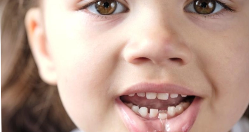 هل يؤثر سقوط الأسنان اللبنية على الأسنان الدائمة؟