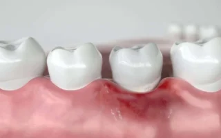 ضعف اللثة عند الكبار