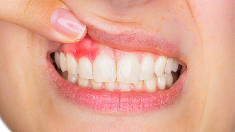 Saignement gingival provoqué par le brossage — signe clinique de gingivite