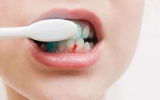 نزيف اللثة عند تنظيف الأسنان