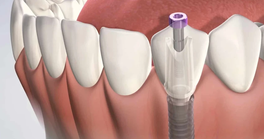 لماذا يُعتبر مجمع بطل للأسنان خيارًا مميزًا في جدة؟