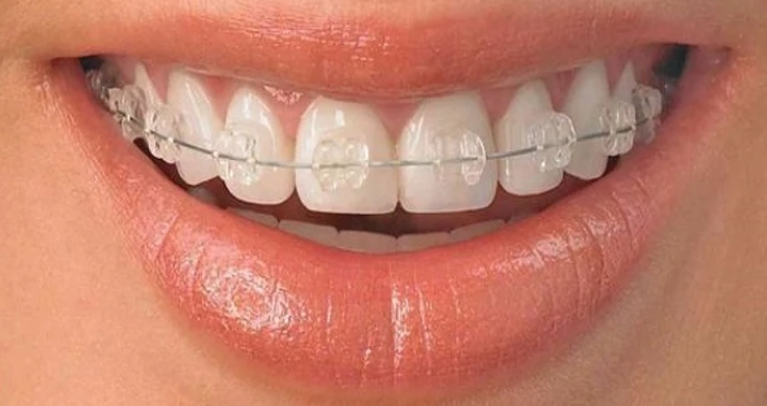 التقويم الشفاف (Invisalign)