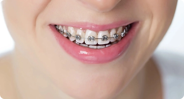 متى تحتاج إلى تقويم الأسنان؟