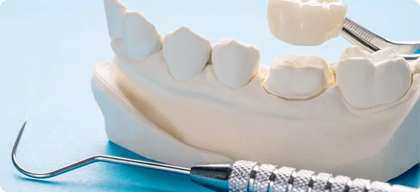 من هم المرشحون لتجميل الأسنان؟