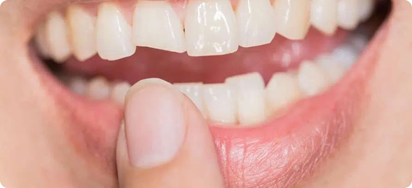 علاج الأسنان المكسورة