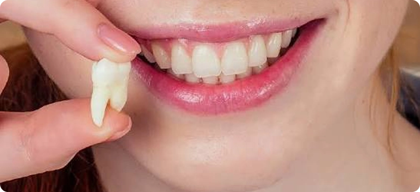 علاج ضرس العقل